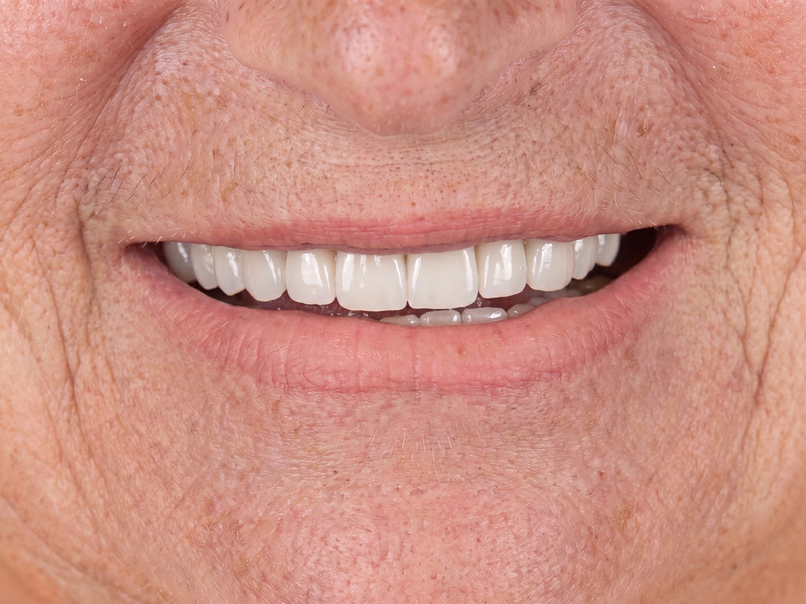 After full mouth ceramic rehabilitation