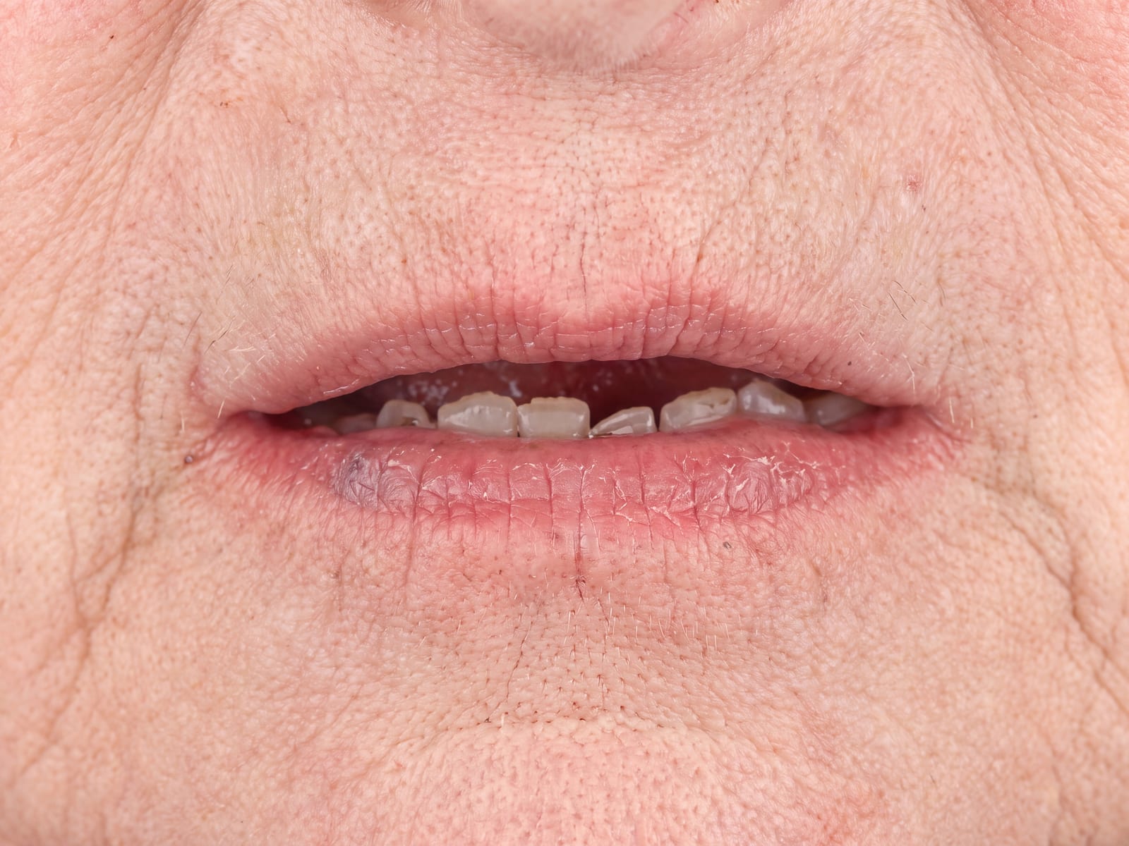 Before full mouth ceramic rehabilitation